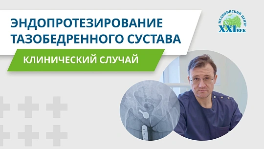 Асептический некроз головки бедренной кости — эндопротезирование тазобедренного сустава